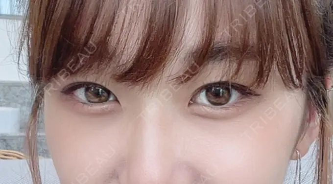 二重埋没 横浜TAクリニック BEFORE メイン用