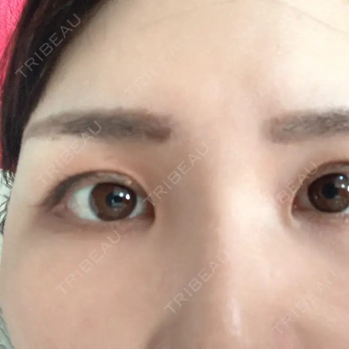 ヒアルロン酸注入（涙袋） TCB東京中央美容外科 金沢院 BEFORE メイン用