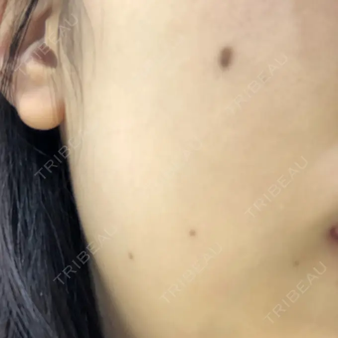 ほくろ・いぼ切除（肌） 吉祥寺アイビークリニック BEFORE メイン用