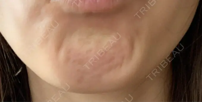 ボトックス（あご） TCB東京中央美容外科 千葉駅前院 BEFORE メイン用