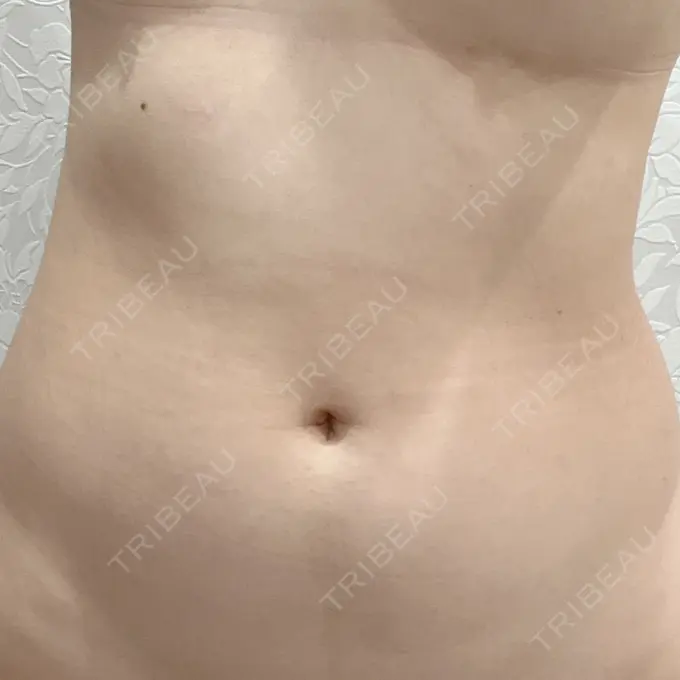 医療痩身（お腹） 吉井クリニック BEFORE メイン用