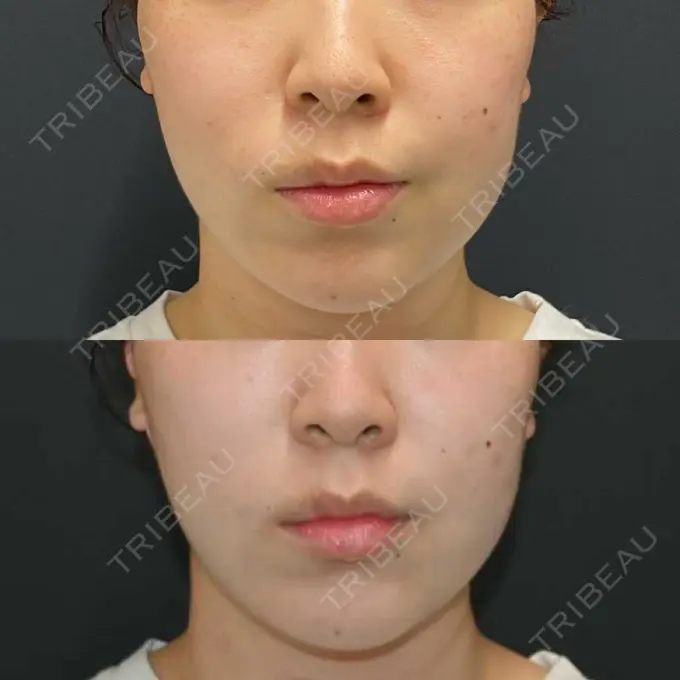 糸リフト / 脂肪吸引（顔） 湘南美容クリニック 長野院 BEFORE メイン用