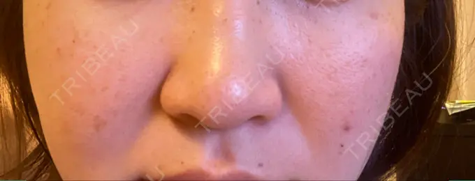 ピーリング（ニキビ・毛穴） / 光治療（フォトフェイシャルなど） アーククリニック BEFORE メイン用