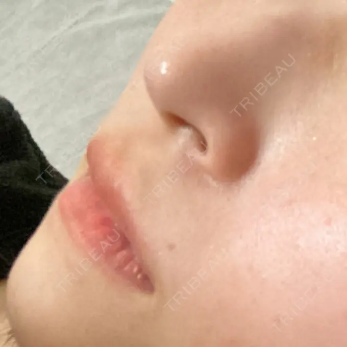 ボトックス（人中） Rosa Beauty Clinic BEFORE メイン用