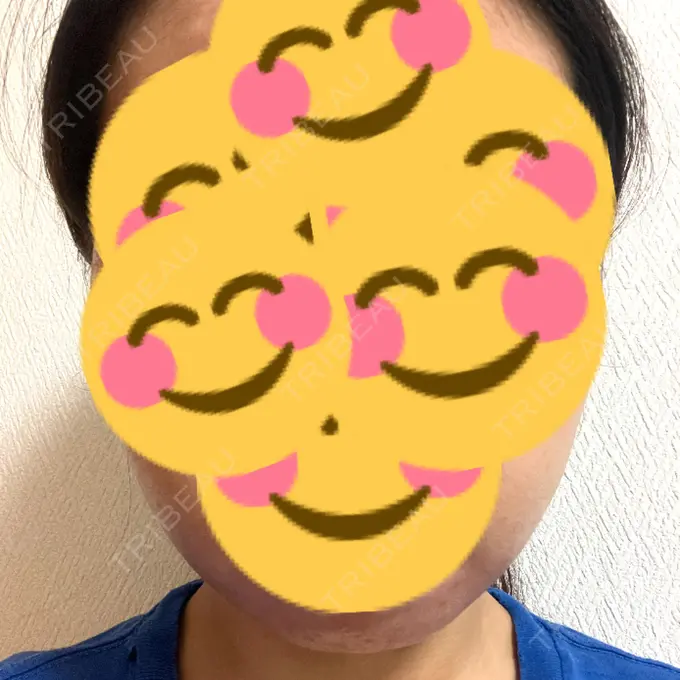 ボトックス（あご） / ヒアルロン酸注入（あご） TCB東京中央美容外科 八王子院 BEFORE メイン用