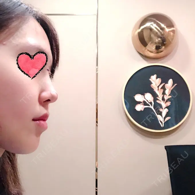 隆鼻術 / 鼻尖形成（切開） / 鼻中隔延長（切開） / 軟骨移植 / その他（鼻） FROM B整形外科 (旧バウム整形外科) BEFORE メイン用