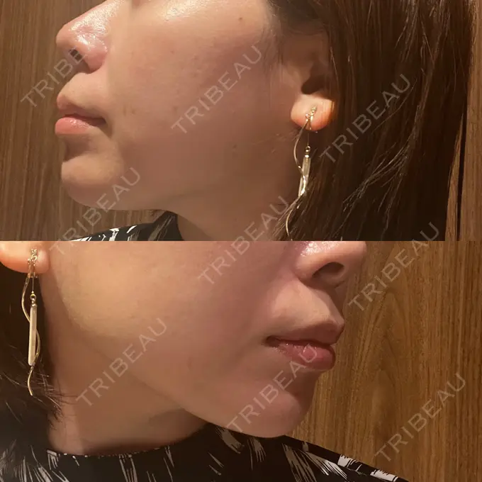 ボトックス（あご） / ヒアルロン酸注入（あご） veary clinic BEFORE メイン用