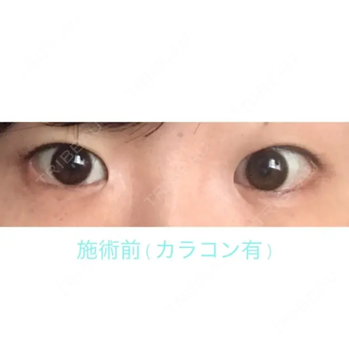 二重埋没 / 目頭切開 湘南美容クリニック 長野院 BEFORE メイン用