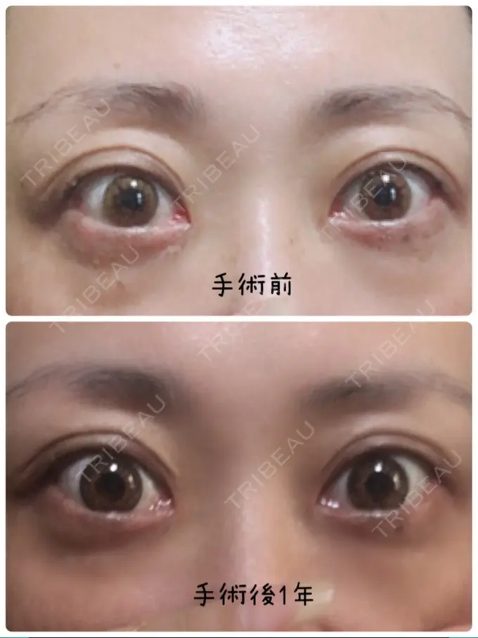 二重埋没 / 目元修正 新宿TAクリニック BEFORE メイン用