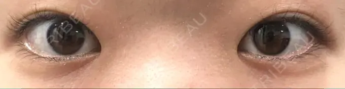 ヒアルロン酸注入（涙袋） しのぶ皮膚科 BEFORE メイン用