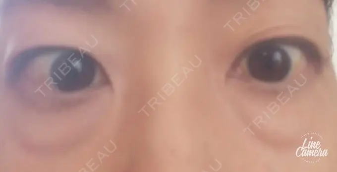 下まぶたの脂肪取り 吉井クリニック BEFORE メイン用