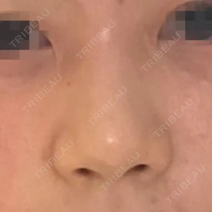 軟骨移植 / 骨切幅寄せ / 鼻中隔延長（非切開） エイト美容外科 BEFORE メイン用