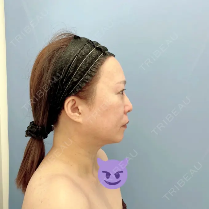 糸リフト / 脂肪吸引（顔） / ジョールファット除去 / その他（輪郭） 湘南美容クリニック 秋葉原院 BEFORE メイン用