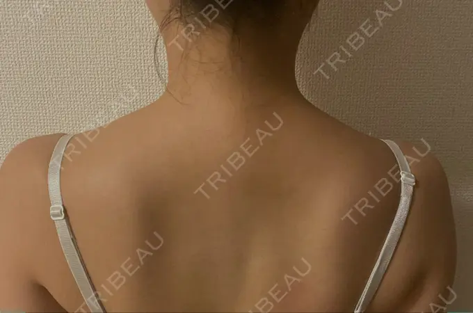 ボトックス（肩） 赤坂プレミアクリニック BEFORE メイン用