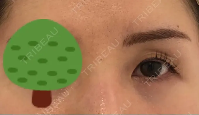 二重埋没 SOL CLINIC BEFORE メイン用