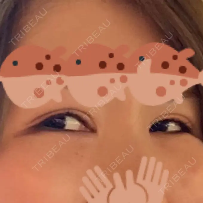 ヒアルロン酸注入（涙袋） / ボトックス（タレ目） アネシス美容クリニック BEFORE メイン用