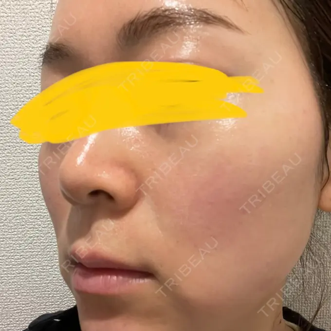 美肌レーザー Rosa Beauty Clinic BEFORE メイン用