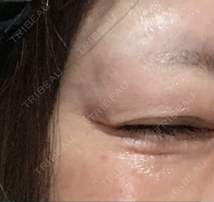 ボトックス（目尻） TCB東京中央美容外科 千葉駅前院 BEFORE メイン用