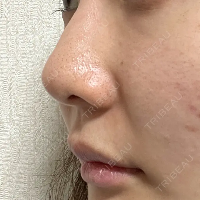 鼻孔縁挙上 シエルクリニック BEFORE メイン用