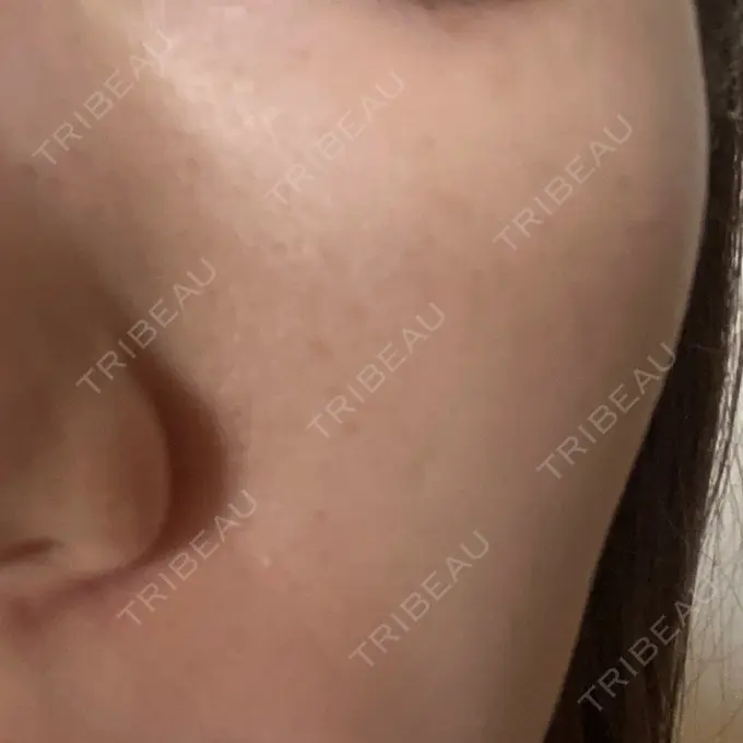 ピコレーザートーニング（美白・肝斑） ルラ美容クリニック 高田馬場院 BEFORE メイン用