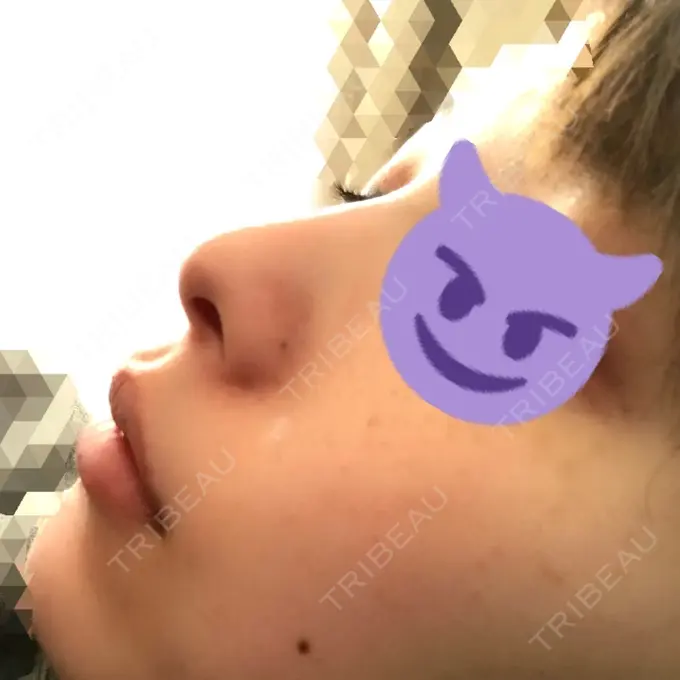 鼻尖形成（切開） / 鼻尖縮小 / その他（鼻） 高崎TAクリニック BEFORE メイン用