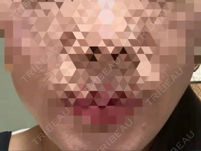 ボトックス（エラ・小顔） / ボトックス（目尻） TCB東京中央美容外科 岡山院 BEFORE メイン用