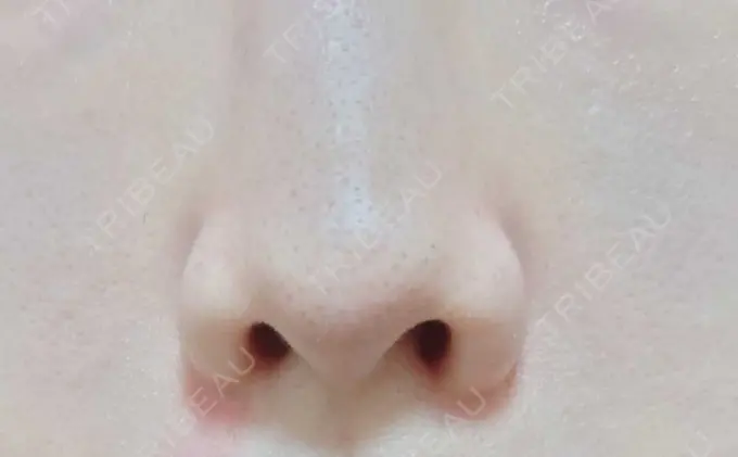 鼻孔縁挙上 シエルクリニック BEFORE メイン用