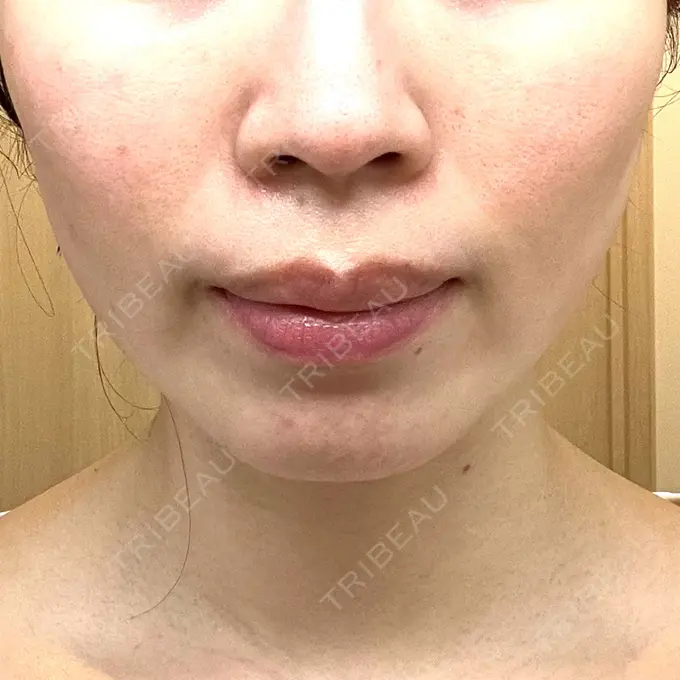 ボトックス（エラ・小顔） LIBER CLINIC BEFORE メイン用