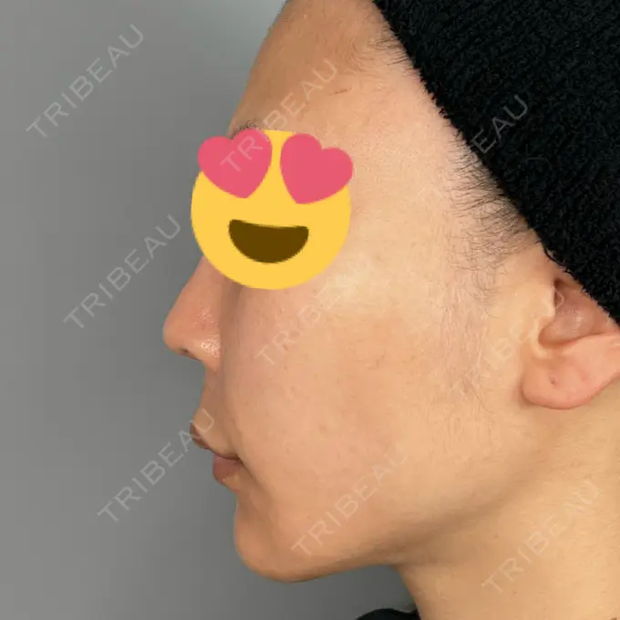 鼻中隔延長（非切開） ASTRA BEAUTY CLINIC BEFORE メイン用