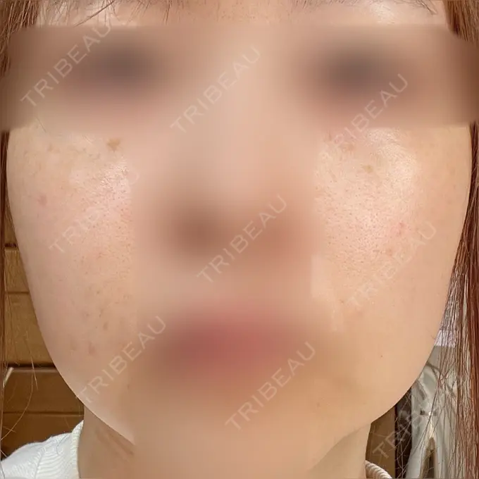 ヴェルヴェットスキン アリエル美容クリニック 大宮院 BEFORE メイン用