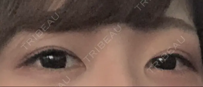 眼瞼下垂（切開） / 目元修正 札幌ル・トロワ ビューティクリニックVogue BEFORE メイン用