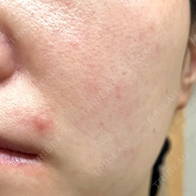 ダーマペン RAISE CLINIC 【レイズクリニック】 BEFORE メイン用