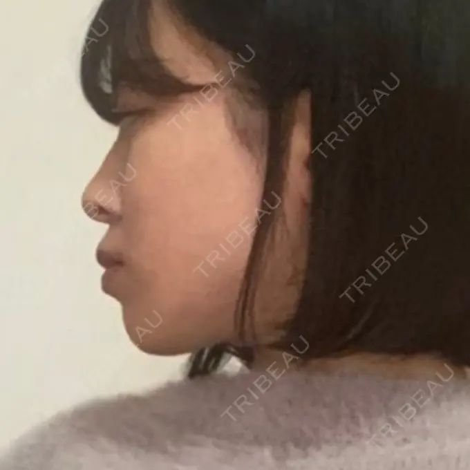 ヒアルロン酸注入（あご） / ボトックス（エラ・小顔） オーキッド美容クリニック東京御徒町 BEFORE メイン用