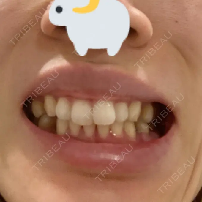 矯正（マウスピース） カトレア歯科・美容クリニック BEFORE メイン用