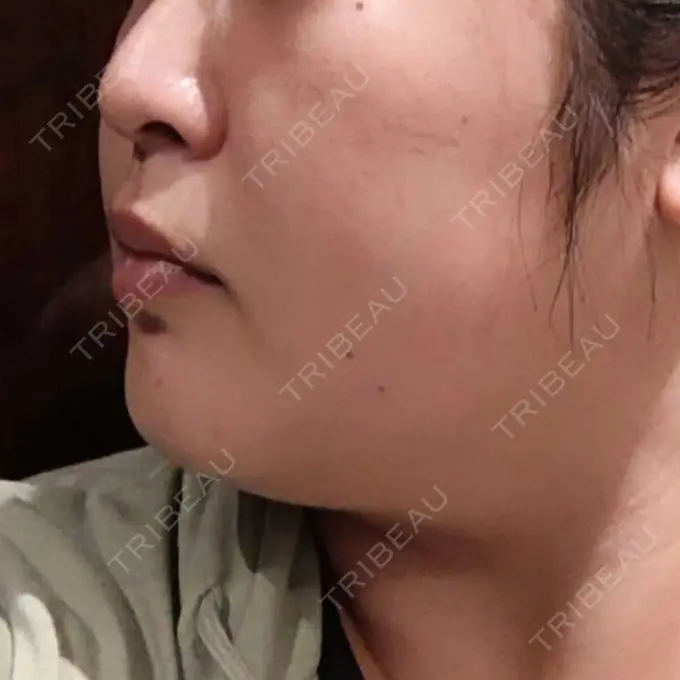 医療痩身（顔） 湘南美容クリニック 名古屋院 BEFORE メイン用