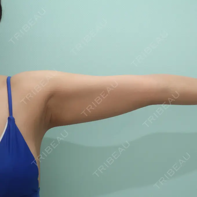 脂肪吸引（二の腕） / 脂肪吸引（お腹） / 脂肪吸引（腰） / その他（ボディ） WOM CLINIC GINZA （ワム クリニック ギンザ） BEFORE メイン用