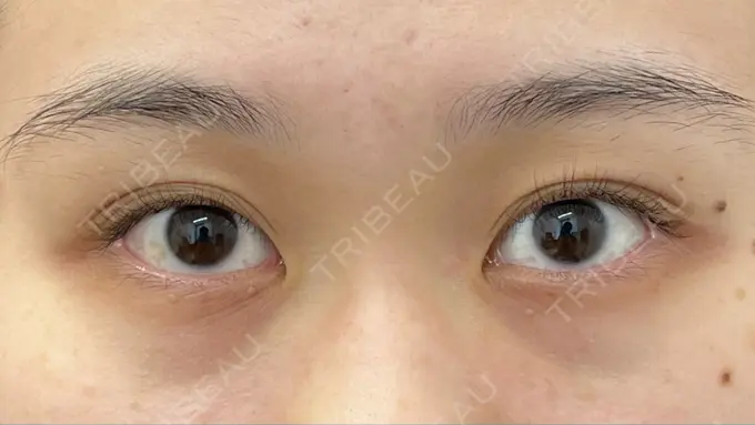 二重埋没 湘南美容クリニック 京都院 BEFORE メイン用