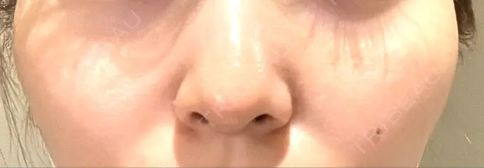 ほくろ・いぼ切除（肌） 吉祥寺アイビークリニック BEFORE メイン用