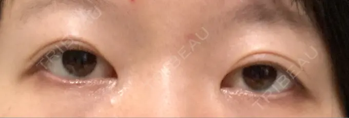 二重切開 / 目元修正 心斎橋コムロ美容外科クリニック BEFORE メイン用