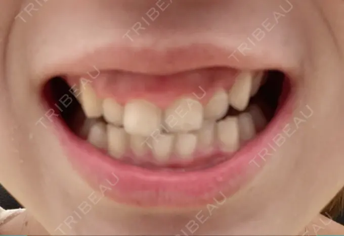 ガミースマイル手術 / 矯正（ワイヤー） / セラミック / その他（審美歯科/矯正歯科） 東京銀座A CLINIC デンタル BEFORE メイン用