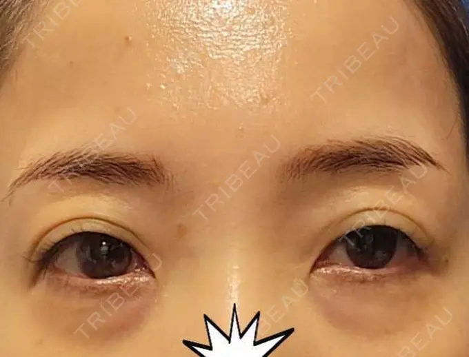 クマ治療 / 下まぶたたるみ取り / その他（目元） セオリークリニック BEFORE メイン用