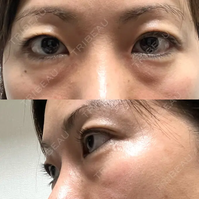 下まぶたたるみ取り セオリークリニック BEFORE メイン用