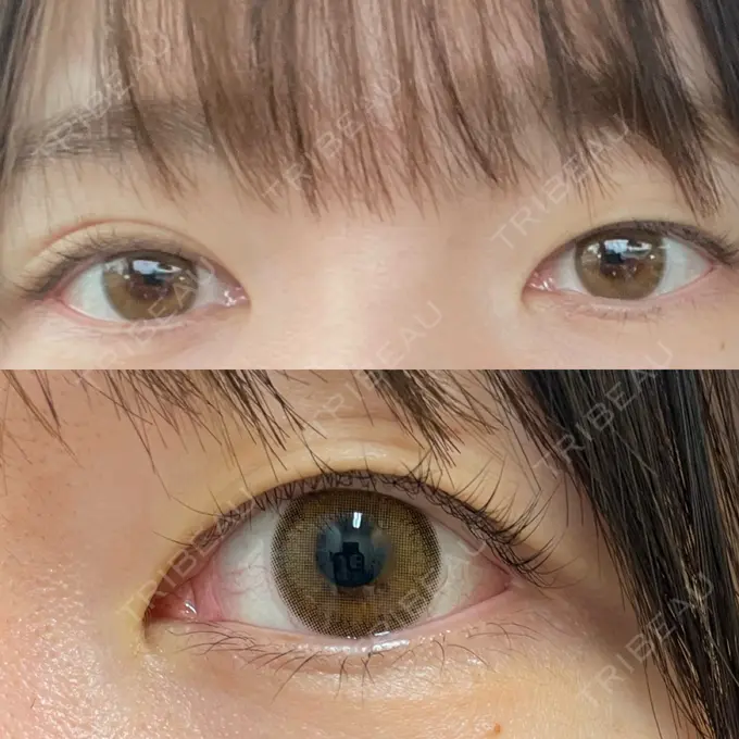 二重埋没 よだ形成外科クリニック BEFORE メイン用