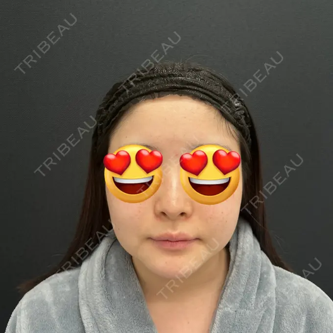 糸リフト / 脂肪吸引（顔） / ジョールファット除去 東京シンデレラ美容外科 池袋院 BEFORE メイン用