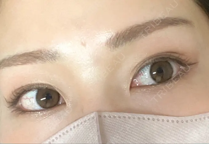 ヒアルロン酸注入（涙袋） / ボトックス（眉間） TCB東京中央美容外科 宇都宮院 BEFORE メイン用