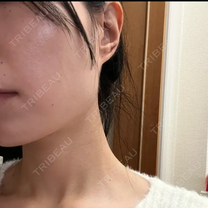 ボトックス（エラ・小顔） TCB東京中央美容外科 千葉駅前院 BEFORE メイン用