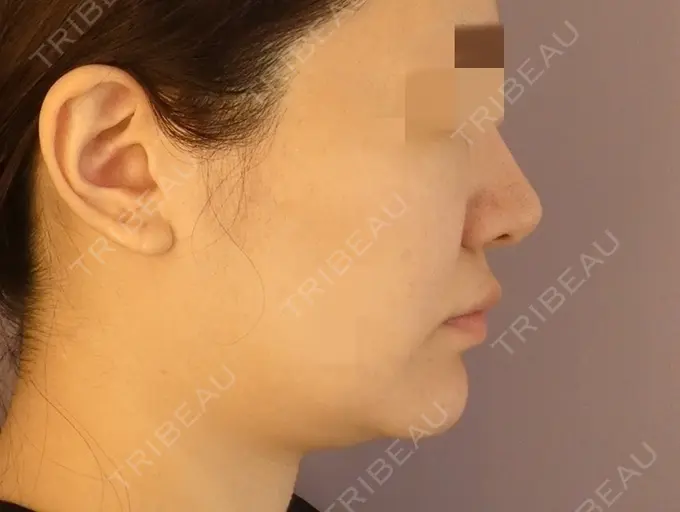 脂肪吸引（顔） / ボトックス（あご） / ヒアルロン酸注入（唇） / ヒアルロン酸溶解 藤・ナチュレ美容クリニック 恵比寿院 BEFORE メイン用