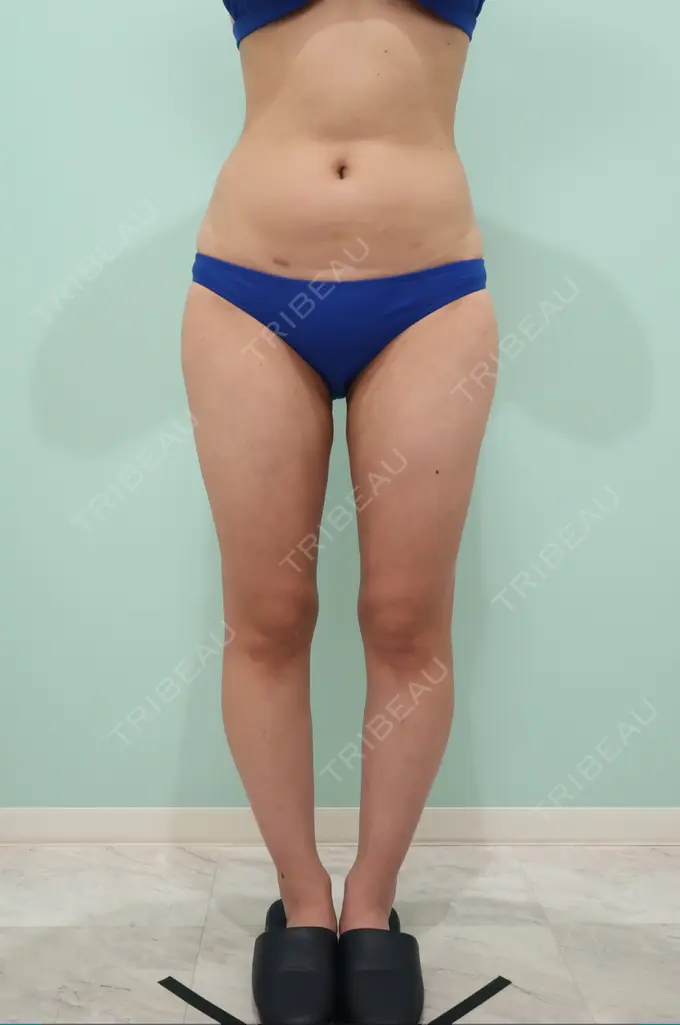 脂肪吸引（脚） / 脂肪吸引（お腹） / 脂肪吸引（腰） / 脂肪注入（お尻） WOM CLINIC GINZA （ワム クリニック ギンザ） BEFORE メイン用