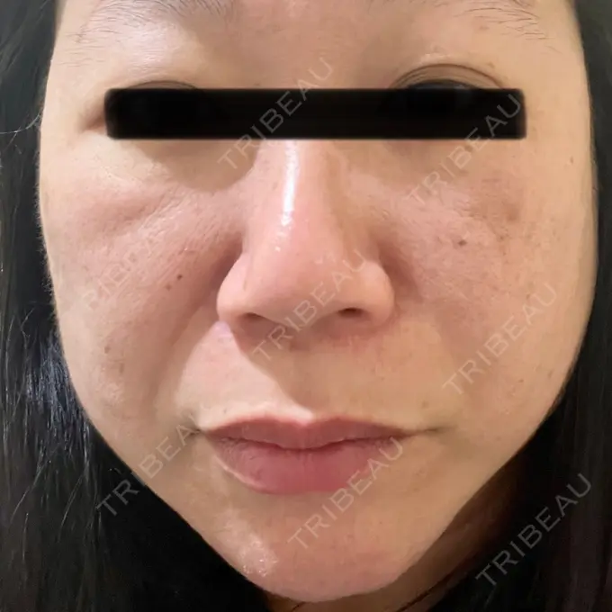 プラセンタ注射 / ピコレーザートーニング（美白・肝斑） フローラクリニック BEFORE メイン用