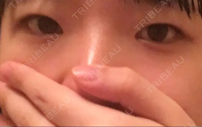 二重切開 / 上まぶたの脂肪取り 聖心美容クリニック 横浜院 BEFORE メイン用